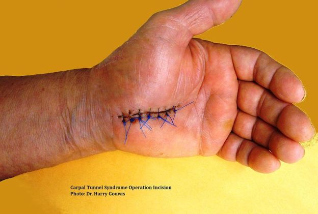 Sutures after incision for carpal tunnel surgery